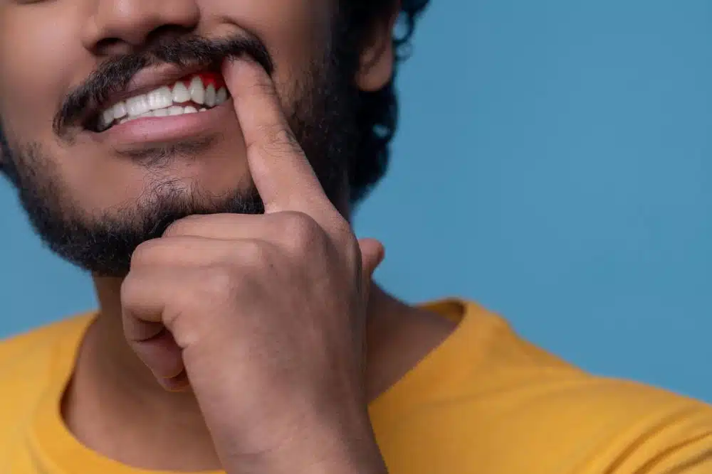 diş eti çekilmesi neden olur