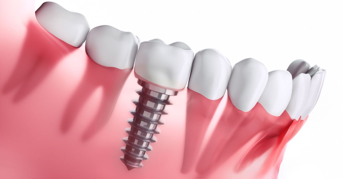 implant diş nedir