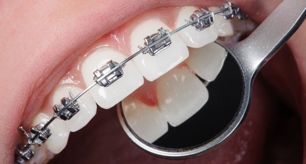 Diş Teli Modelleri: Hangi Ortodontik Tedavi Size Uygun