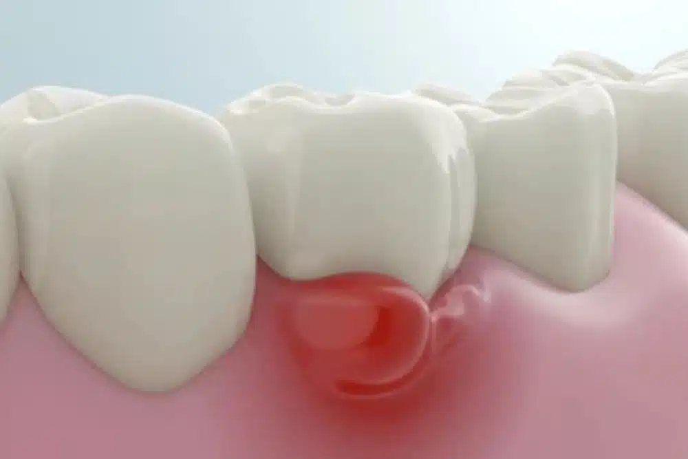 diş eti iltihabı belirtileri