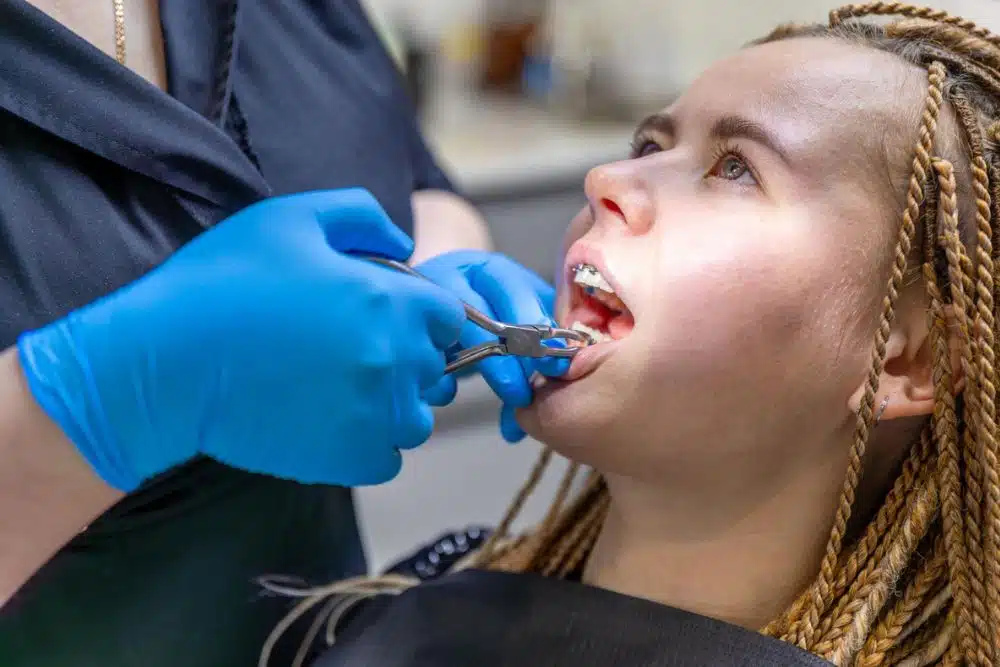 Diş hekimi hastanın dişinden diş teli braketini çıkarıyor