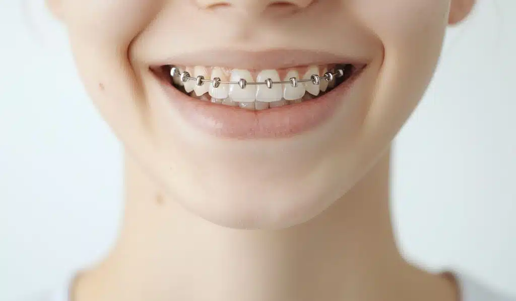 Metal diş telleriyle gülümseyen dişler